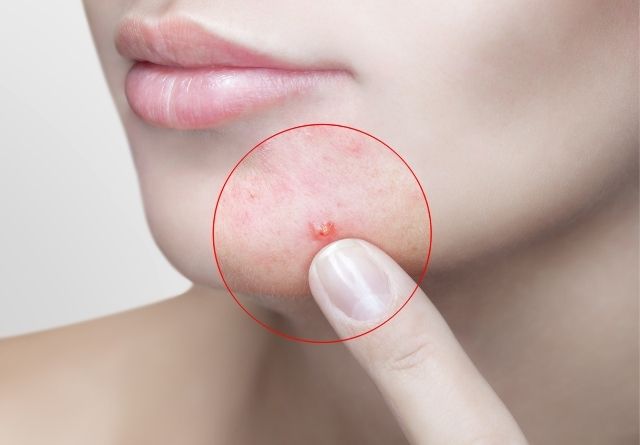 El acné en la cara es el más común
