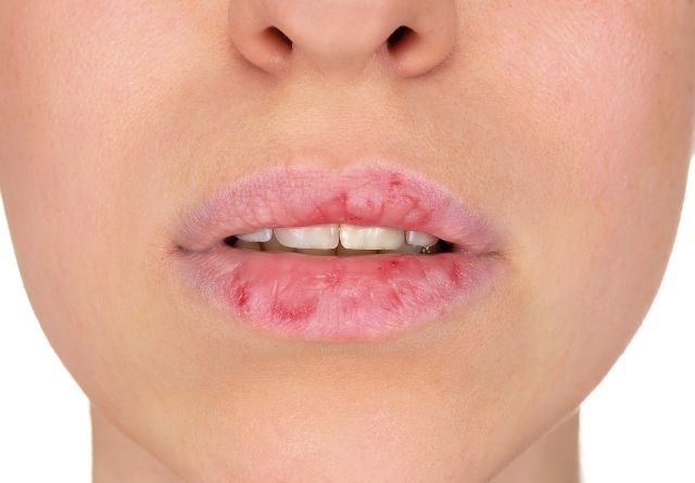 Para proteger los labios del frío, es primordial aplicar dos o tres veces al día un producto específico para los labios