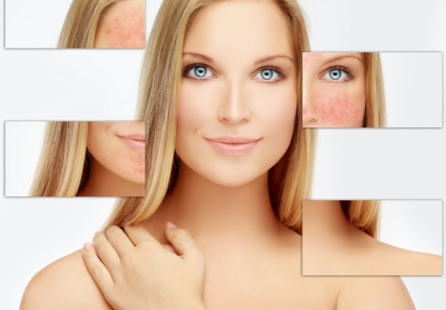 Los síntomas de la piel rosácea son rubor o enrojecimiento en las mejillas.