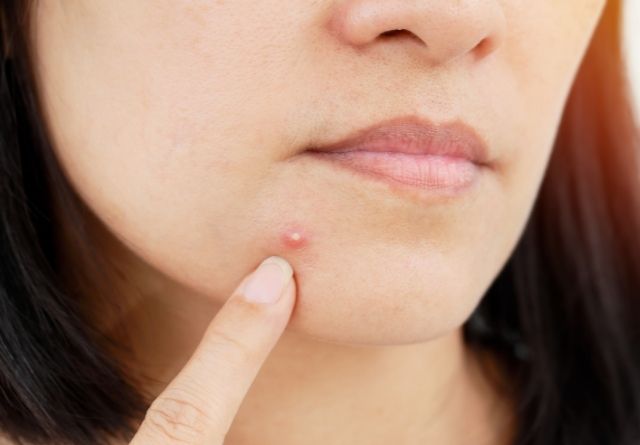 El estrés puede causar acné en la piel de los adultos.