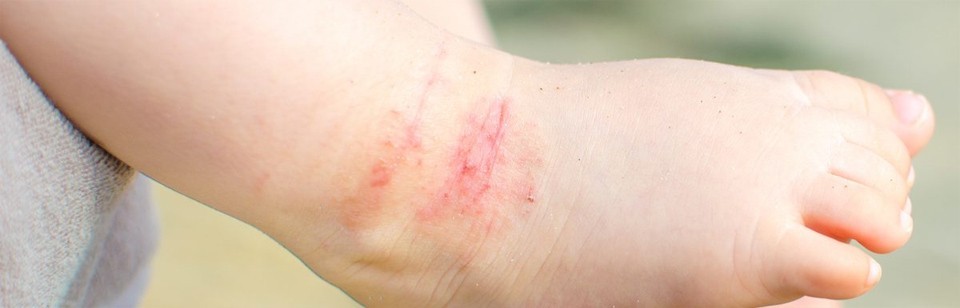 Dermatitis Atópica y Pañal